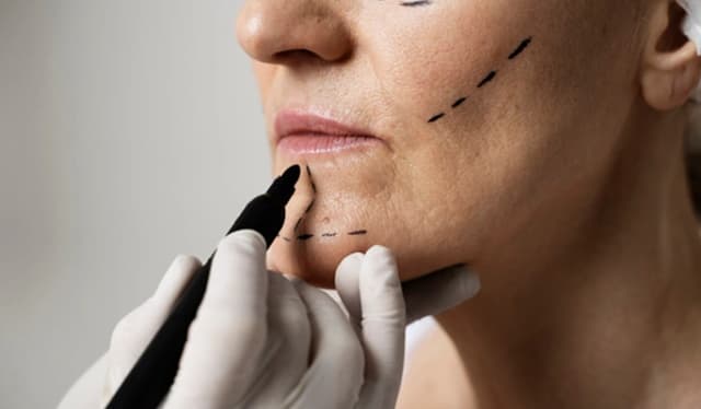 Chin Liposuction