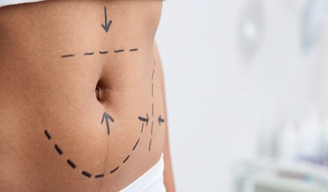 Mini Tummy Tuck