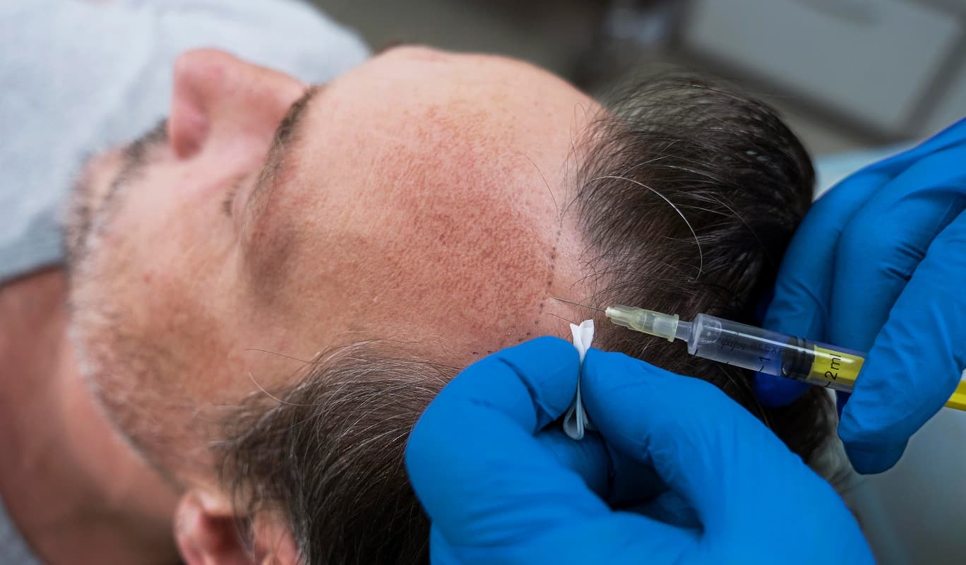 Hair Transplant